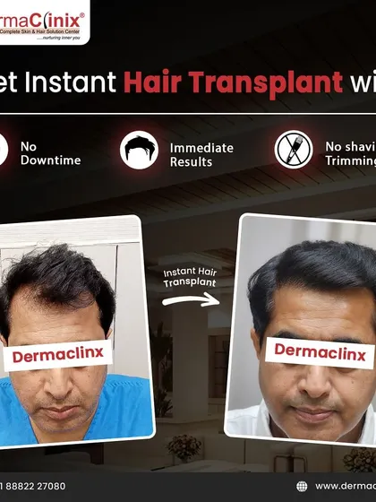 Another example of our Instant Hair Transplant, perfect for those who want immediate results without any interruption to their daily life. The Long Hair FUE method makes this possible.