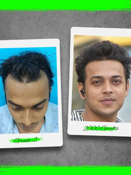 From Grade 2 baldness to a full head of hair with 2000 grafts. This patient's transformation showcases the natural and aesthetically pleasing results we deliver.