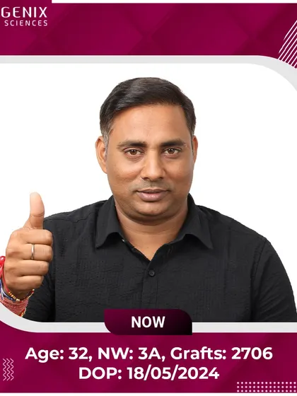 A 32-year-old patient's journey from Grade 3A baldness to a full, confident look after 2706 grafts.