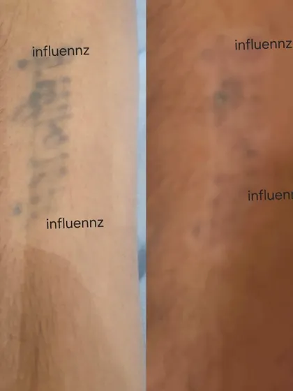Another example of a name tattoo fading effectively. The laser breaks down the ink, and with each session, the tattoo becomes lighter until it is no longer visible.