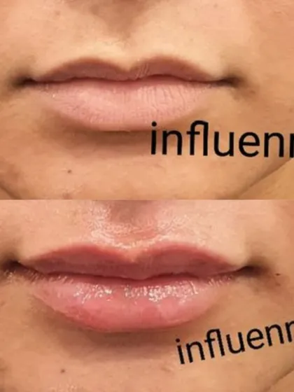 A classic before and after of a lip filler treatment, showcasing enhanced volume and a beautifully defined cupid's bow.
