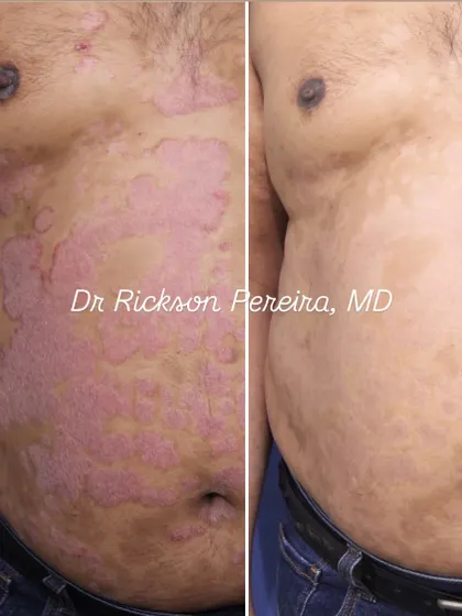 This is the power of evidence-based medicine. This patient lived with severe psoriasis for 17 years, trying various alternative therapies with no success. Using a modern biologic therapy, we achieved near-complete skin clearance in just two weeks, restoring not just his skin but his confidence and quality of life.
