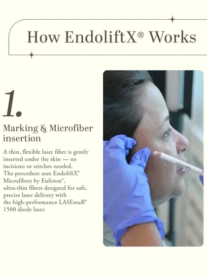 The first step of the EndoliftX procedure involves marking the treatment area and gently inserting a thin, flexible laser fiber under the skin. No incisions or stitches are needed, making it a safe and precise method for laser delivery.