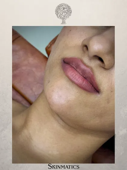 This patient received a combination of lip and chin fillers. By adding 1ml of filler to each area, we achieved a more balanced lower face and enhanced the overall facial profile.