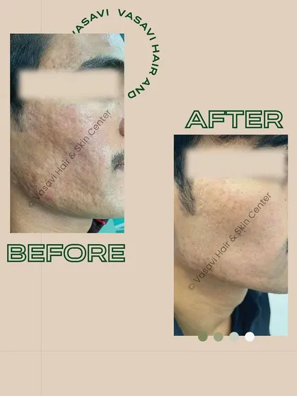 Here you can see the progress made on a patient with significant acne scarring. Through a series of treatments including microneedling and fractional CO2 laser, we were able to visibly reduce the depth of the scars and improve the overall skin surface.