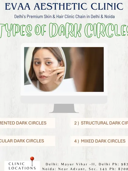 Understanding the type of dark circle is key to effective treatment. This graphic explains the different classifications, including pigmented, structural, vascular, and mixed types.