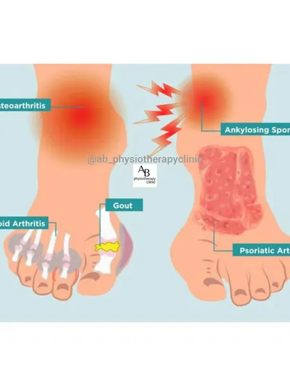 Arthritis can affect the feet in many ways. This infographic shows how different types, including Osteoarthritis, Gout, and Psoriatic Arthritis, present in the foot and ankle joints, causing pain and inflammation.