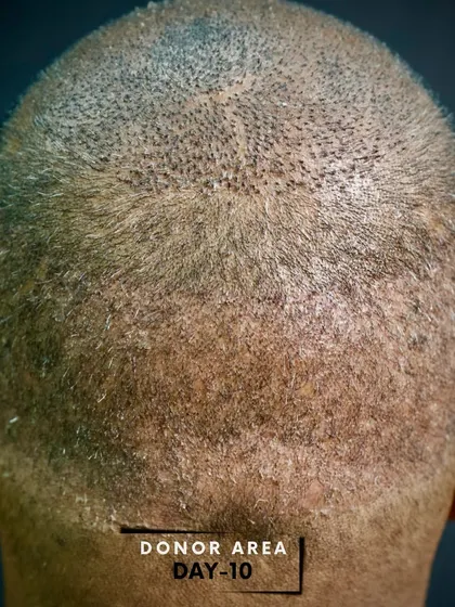 This is the donor area 10 days after a 3500-graft FUE procedure. You can see how quickly and cleanly the area heals, with the remaining hair providing full coverage.
