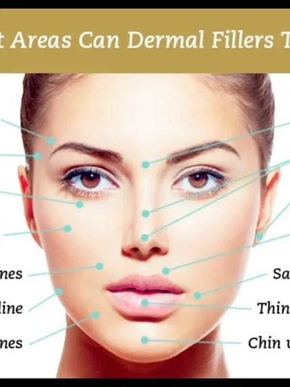 This graphic illustrates the many areas that can be treated with dermal fillers. From restoring volume in the cheeks and temples to smoothing laugh lines and defining the jawline, fillers are a versatile tool for facial rejuvenation.