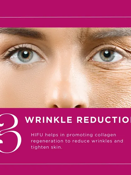 By promoting collagen regeneration deep within the skin, HIFU is very effective at reducing the appearance of wrinkles. The new collagen helps to plump and tighten the skin, smoothing out fine lines.