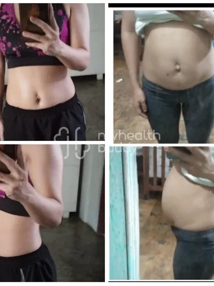 Healing Diastasis Recti is a journey of rebuilding strength from the inside out. This transformation shows a significant reduction in the abdominal gap, achieved through specific, safe, and targeted core exercises.