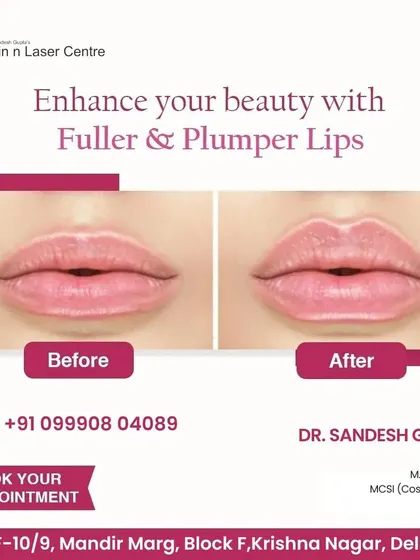 Here you can see the before and after of a lip enhancement procedure. Using dermal fillers, I can create fuller and more defined lips, enhancing your natural beauty and improving the overall balance of your facial features.