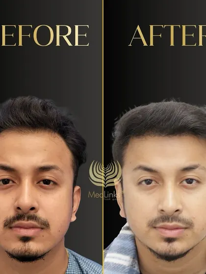 A great before and after transformation. The patient's new hair looks natural, dense, and has completely revitalized his appearance.