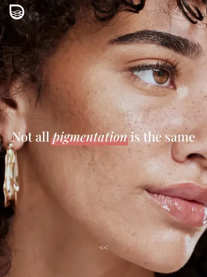 It is a common misconception that all dark spots are the same. Different types of pigmentation, such as sun-induced tanning versus hormonal melasma, require distinct and tailored treatment strategies.