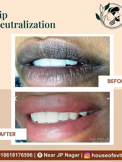 A fantastic result from a Lip Neutralization treatment. The client's lips are visibly brighter and have a uniform color, enhancing her beautiful smile.