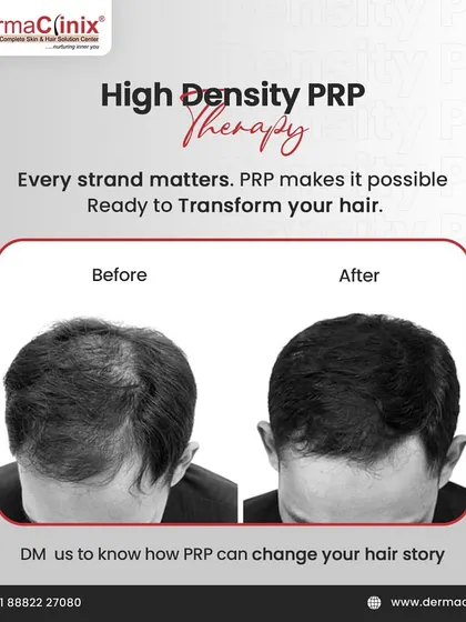 This before-and-after photo shows the transformative power of High-Density PRP. It can take hair from thinning to thriving by boosting natural growth and density.