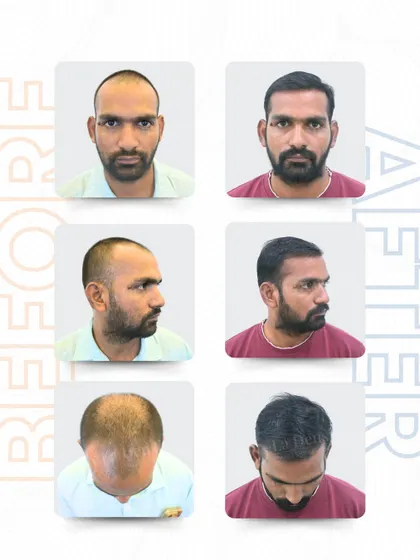 Here you can see Durugesh's journey from every angle. The 3,447 grafts were strategically placed to restore his hairline and crown, resulting in a look that feels real and effortless, as if this is how he was always meant to look.