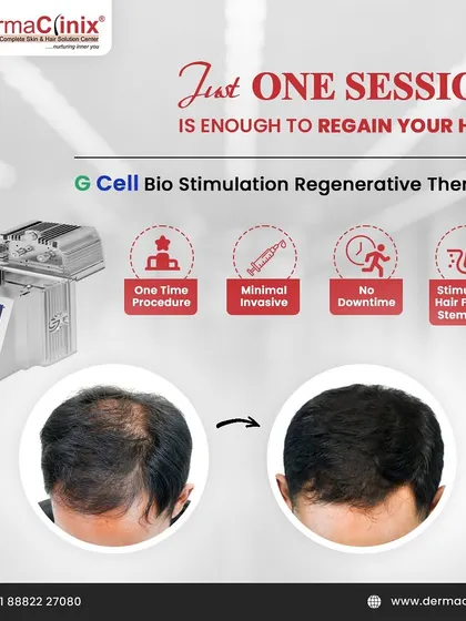 Imagine regaining your hair in just one session. Our GCell Bio Stimulation Regenerative Therapy is a one-time, minimally invasive procedure with no downtime that uses your body's own stem cells to reactivate hair follicles.