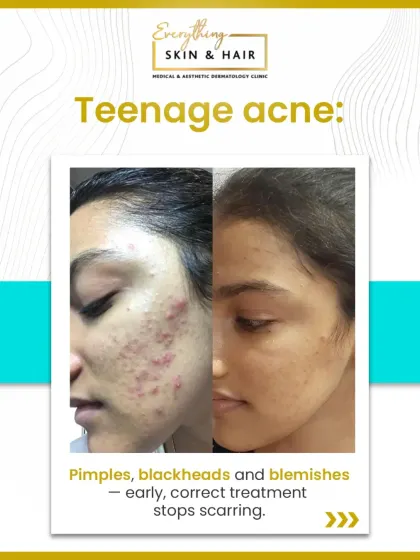 This before-and-after result highlights the successful treatment of teenage acne. By addressing pimples, blackheads, and inflammation early, we effectively cleared the active breakouts and prevented the formation of permanent scars.