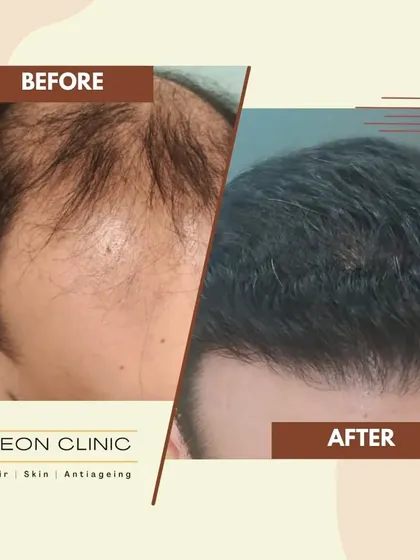 A powerful before-and-after showcasing significant regrowth and coverage. Our goal is to help you regain a full head of hair.