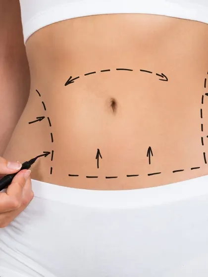 The surgical markings for a tummy tuck are essential for a successful outcome. They guide the removal of excess skin and help in creating a toned and flat abdominal profile.