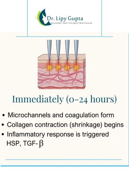 Immediately after microneedling, microchannels are formed, triggering an inflammatory response and causing collagen to contract. This is the first step in the skin's renewal process.