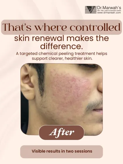 Here is the same patient's skin after just two sessions of a controlled, targeted chemical peel. The treatment has visibly calmed the active breakouts, reduced redness, and initiated a healthier skin renewal process, leading to a much clearer complexion.