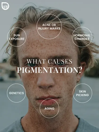 This visual chart outlines the primary causes of pigmentation, from genetics and sun exposure to hormonal changes and skin picking. Identifying the cause is key to effective treatment and prevention.