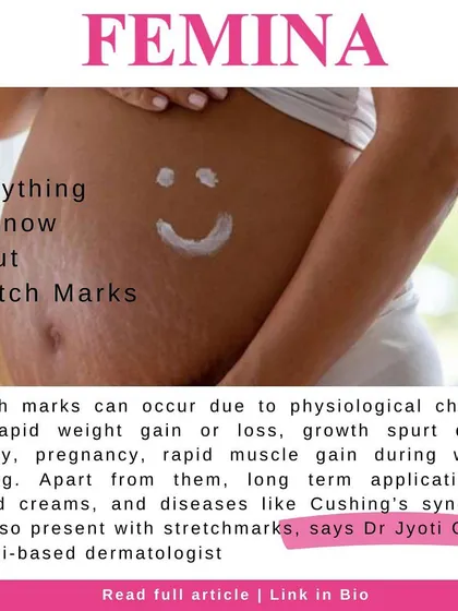 Stretch marks are a common concern, especially during pregnancy or periods of weight change. I explain what causes them and discuss the treatment options available to reduce their appearance, particularly when addressed early.