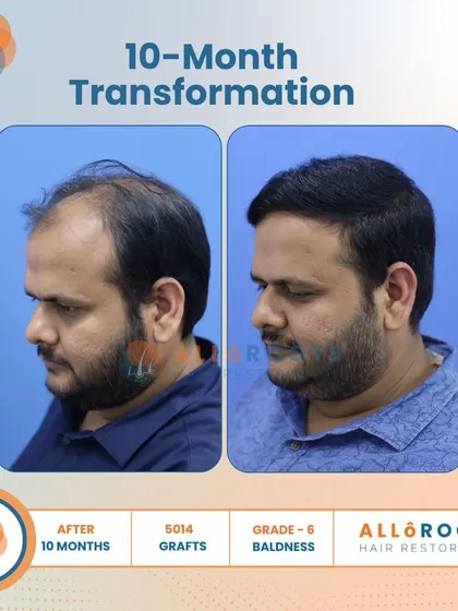 This 10-month transformation is a powerful example of tackling advanced Grade 6 baldness. With 5014 grafts, we achieved remarkable coverage and density, as seen from all angles.