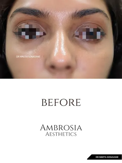 This is the "before" shot of a patient concerned with under-eye hollowness and dark circles, which created a tired appearance.