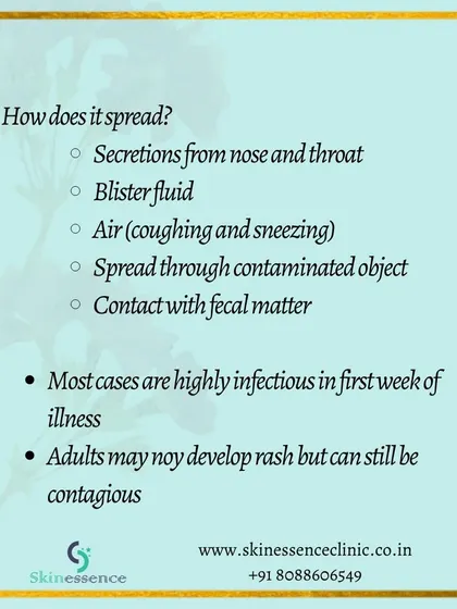 HFMD is highly infectious and spreads through respiratory secretions, blister fluid, and contaminated objects. It is most contagious during the first week of illness, so proper precautions are essential to prevent transmission.