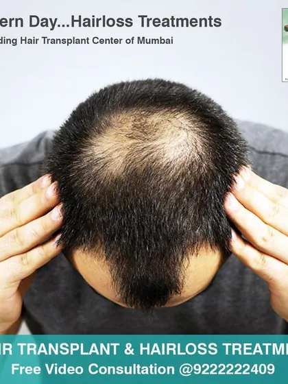 We offer modern day hair loss treatments at our leading hair transplant center in Mumbai. Whether you need non surgical solutions or a full transplant, we provide free video consultations to guide you.