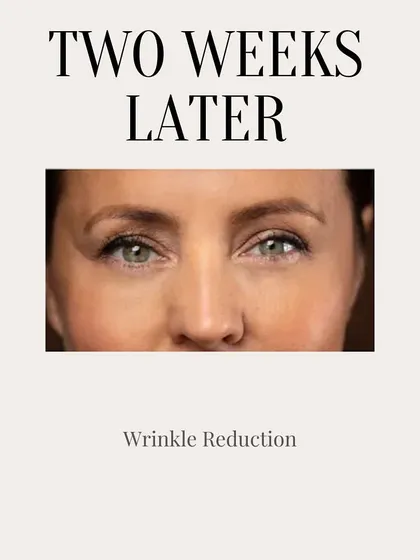 Two weeks after a Botox treatment, you can see the full effect. Wrinkles are significantly reduced, and the skin appears smoother and more relaxed. This is when the magic of Botox is most visible.