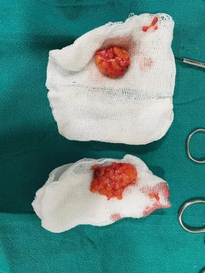 These are the buccal fat pads that were removed from a patient's cheeks. Removing this specific pocket of fat helps to slim the lower face, enhancing the natural bone structure for a more defined look.
