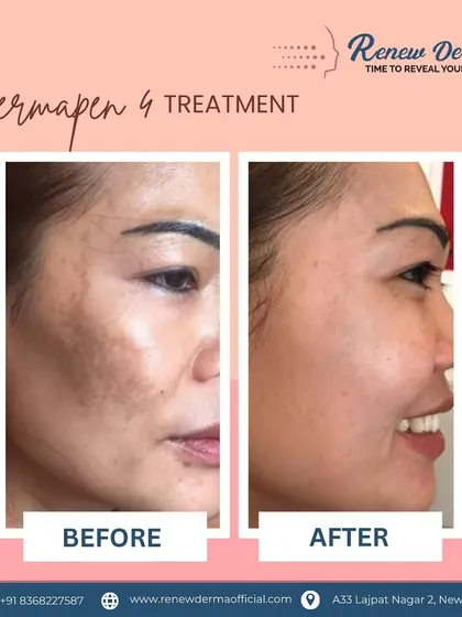 A stunning transformation using Dermapen 4. This treatment effectively addressed deep pigmentation and uneven texture, leaving the skin visibly clearer and brighter.