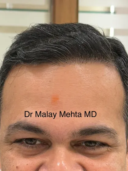 A frontal view of a mature, healed hairline. The density is built up gradually from the front to the back, which avoids an artificial, "wall of hair" appearance and contributes to a truly natural look.