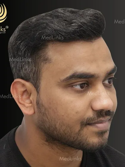 The final result from the side, showing a natural and dense hairline.