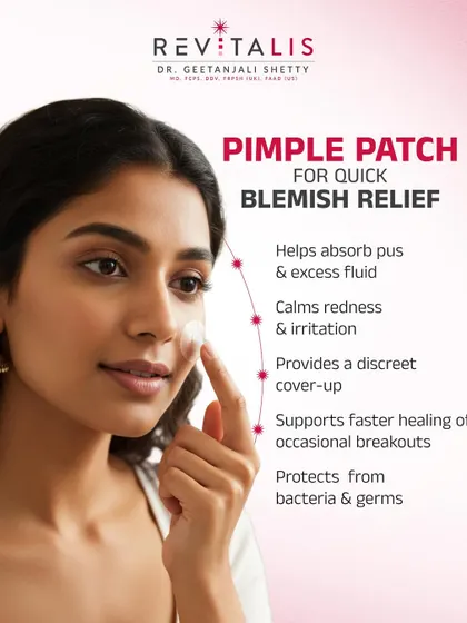 How Pimple Patches Provide Quick Blemish Relief. Pimple patches are more than just a cover-up. They are hydrocolloid dressings that absorb fluid, calm redness, and protect the blemish from bacteria and picking, helping it heal faster.