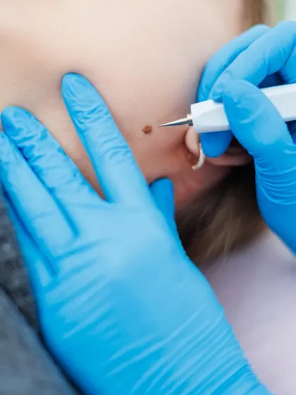 RF Cautery is a preferred method for removing small growths like skin tags or moles on the face and body. The procedure is quick, nearly painless, and the precision of the tool helps ensure that scarring is minimal.