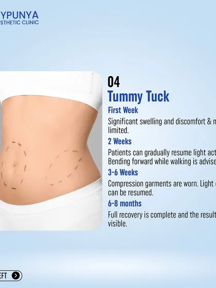 This is the recovery timeline for a tummy tuck. It is a more involved recovery, with light activities resuming at 2 weeks and full recovery taking 6-8 months.