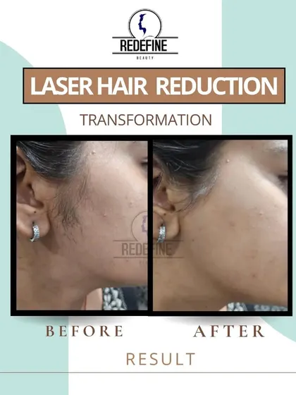 Another look at a successful facial hair removal on the sideburn area. Our goal is to make your skin smooth and even-toned, so you feel confident without makeup.