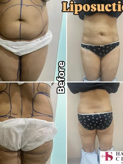 A comprehensive liposuction result for the abdomen and back. The pre-operative markings show the areas I targeted to remove localized fat deposits. The after photo displays a significantly improved body shape and proportion, highlighting how body sculpting can address areas resistant to diet and exercise.