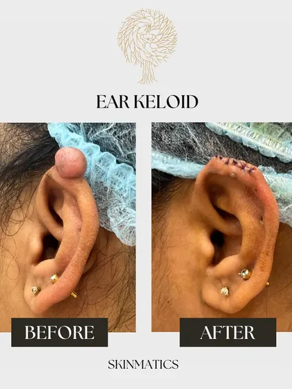 Here is another example of an ear keloid transformation. This type of raised scar often occurs after piercings. Our treatment involves careful removal of the keloid tissue, followed by steps to minimize the chance of recurrence, restoring the ear's natural contour.