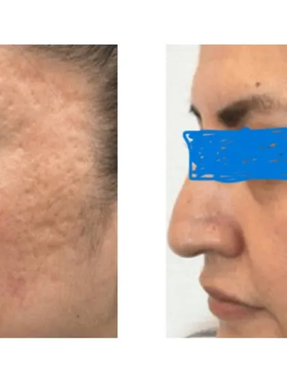 A clear reduction in both acne scars and hyperpigmentation after a course of MNRF. This technology is safe for Indian skin tones and effectively addresses multiple concerns at once, from texture to tone.