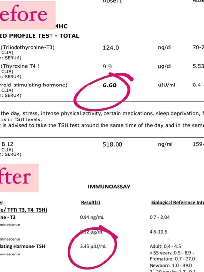 This is what I mean by "healing from within." By analyzing blood reports beyond the standard ranges, we identified the underlying issues and, in just two months, helped this client naturally reverse high TSH levels, showcasing a significant improvement in their thyroid health.