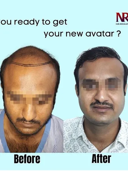 This is the new avatar we help our clients achieve. On the left, you see significant hair loss due to male pattern baldness, and on the right, the final result after our high-density Micro-FUE hair transplant. This transformation took place over 12 months.
