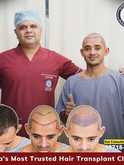 A great result for this patient with Grade 3 baldness. We used 3380 grafts to restore his hairline and density, and this collage shows the clear transformation.