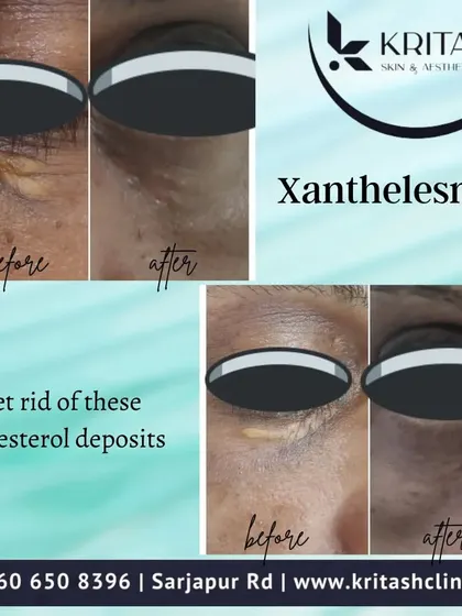 Here you can see the results of Xanthelasma removal. These cholesterol deposits on the eyelids can be safely and effectively removed in the clinic using techniques like CO2 laser or radiofrequency ablation, which offer precise removal and promote better healing.
