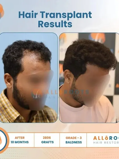 This 10-month result for a Grade 3 baldness case, using 2806 grafts, showcases a significant improvement in density and a perfectly restored hairline from all angles.